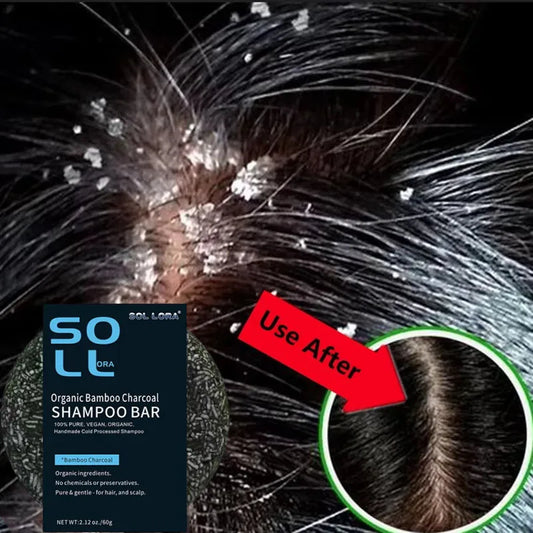 Fast Anti Dandruff Hair Treatment Soap with Itching Scalp repair , Cleaning Exfoliating and Antipruritic Hair Care