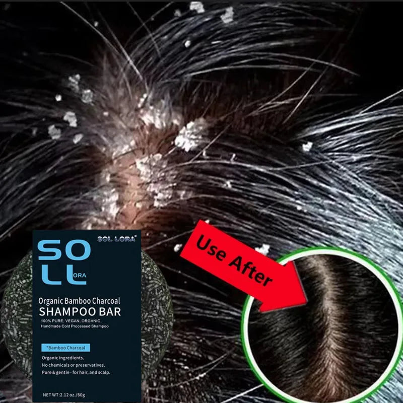 Fast Anti Dandruff Hair Treatment Soap with  Itching  Scalp repair , Cleaning Exfoliating and Antipruritic Hair Care