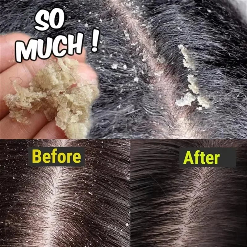 Fast Anti Dandruff Hair Treatment Soap with  Itching  Scalp repair , Cleaning Exfoliating and Antipruritic Hair Care
