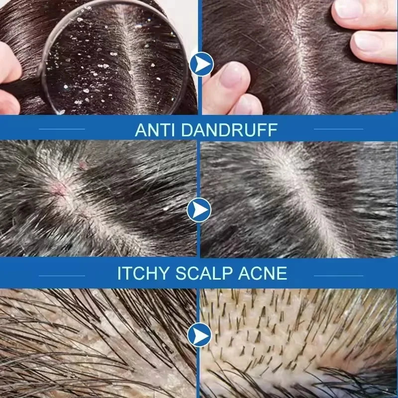 Fast Anti Dandruff Hair Treatment Soap with  Itching  Scalp repair , Cleaning Exfoliating and Antipruritic Hair Care