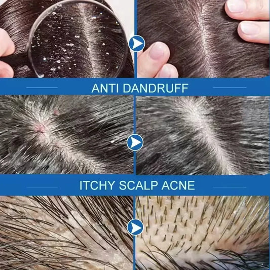 Fast Anti Dandruff Hair Treatment Soap with  Itching  Scalp repair , Cleaning Exfoliating and Antipruritic Hair Care